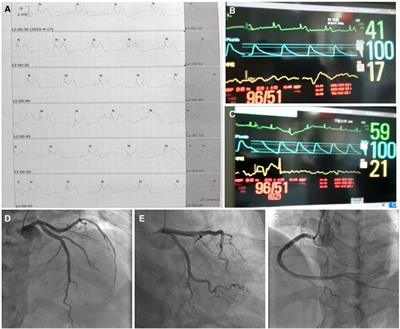 Diltiazem is a useful and effective medication for reversal of coronary artery spasm-induced complete atrioventricular block: A case report
